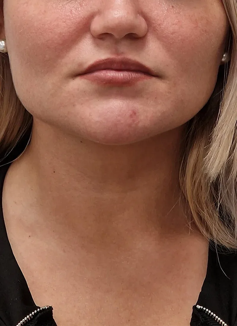 Dermal fillers, real patient of Dr Q, before