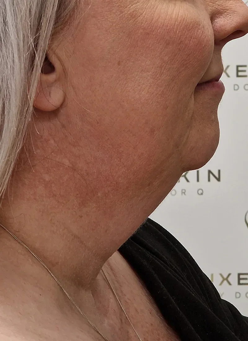 Double chin, real patient of Dr Q, before
