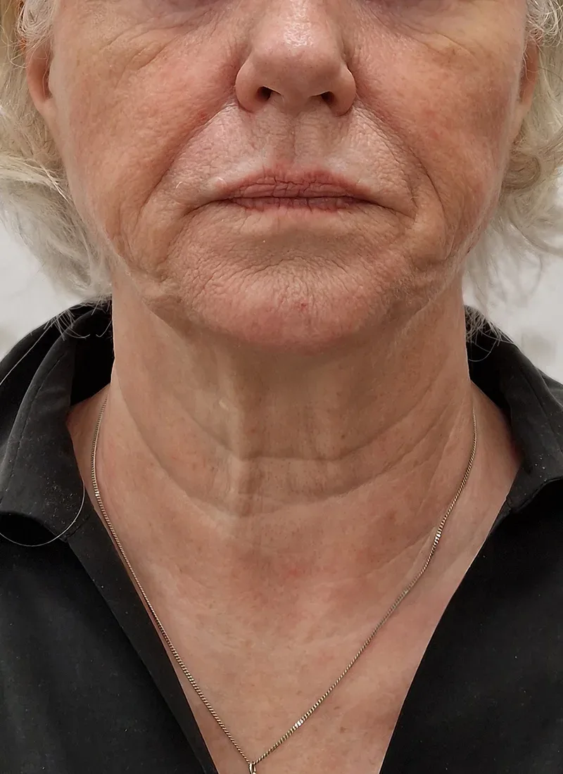 Non surgical facelift, real patient of Dr Q, before