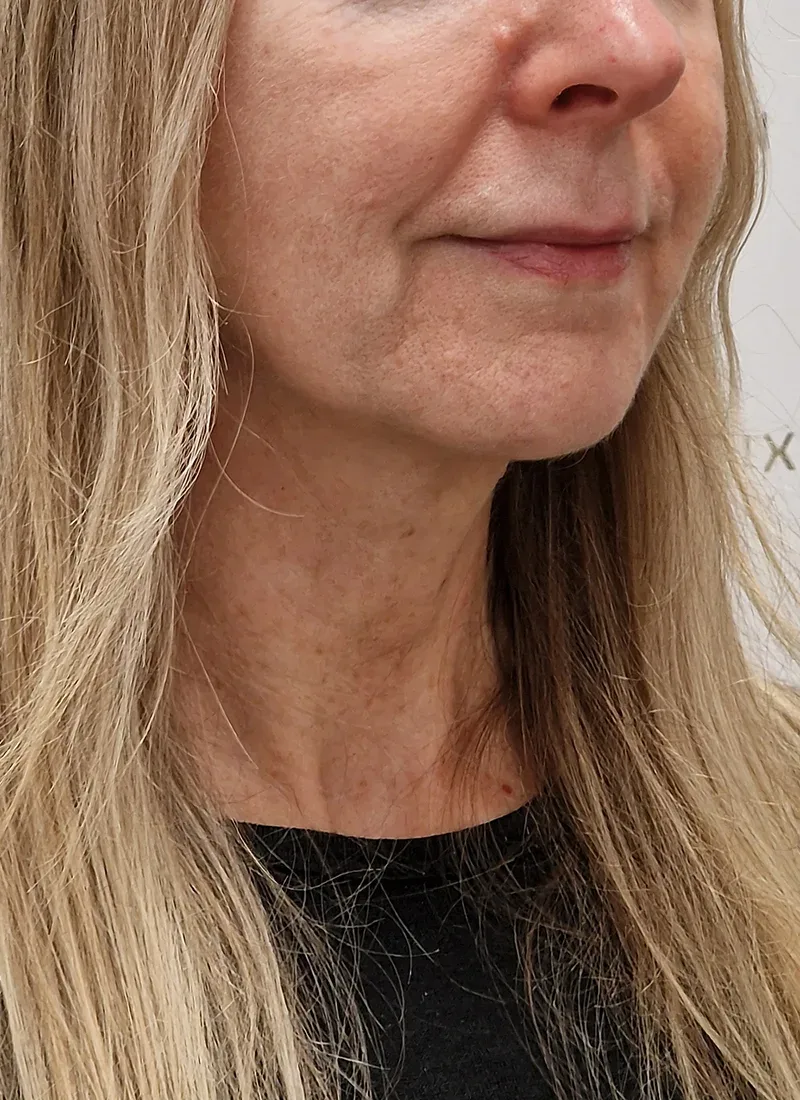 Q Lift, real patient of Dr Q, before